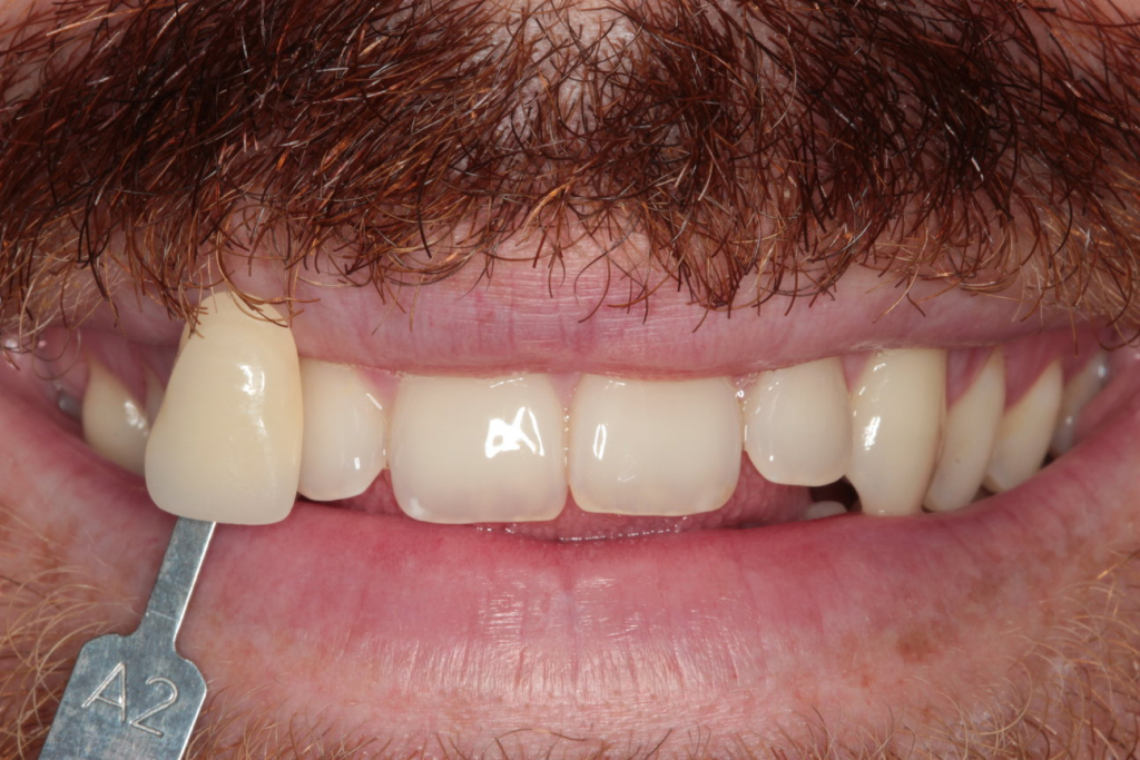 Teeth whitening lewisham